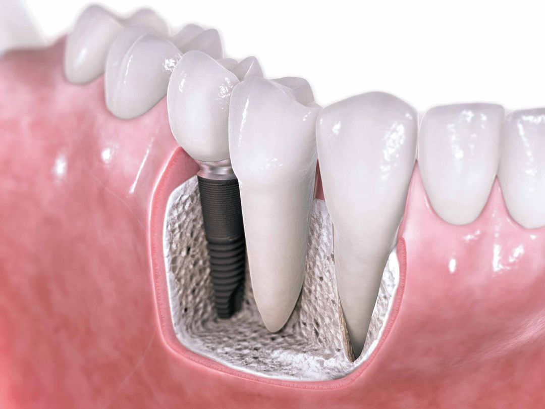 impianti dentali - Dott.Riccardo Giorgi Studi Dentistici a La Spezia