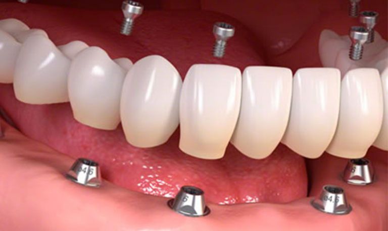 denti fissi su impianti - Dott.Riccardo Giorgi Studi Dentistici a La Spezia