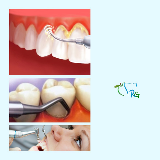 detartrasi - Dott.Riccardo Giorgi Studi Dentistici a La Spezia