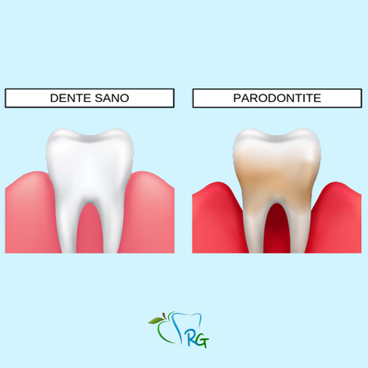 gengivite e parodontite - Dott.Riccardo Giorgi Studi Dentistici a La Spezia