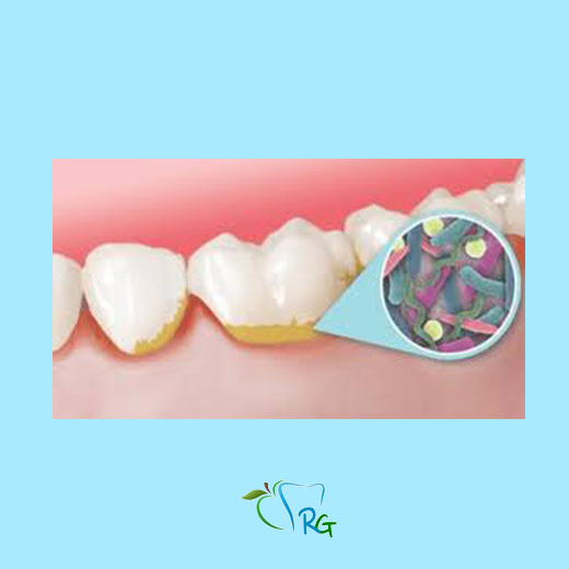 Placca batterica dentale - Dott.Riccardo Giorgi Studi Dentistici a La Spezia