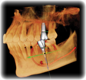 chirurgia guidata con dima chirurgica - Dott.Riccardo Giorgi Studi Dentistici a La Spezia