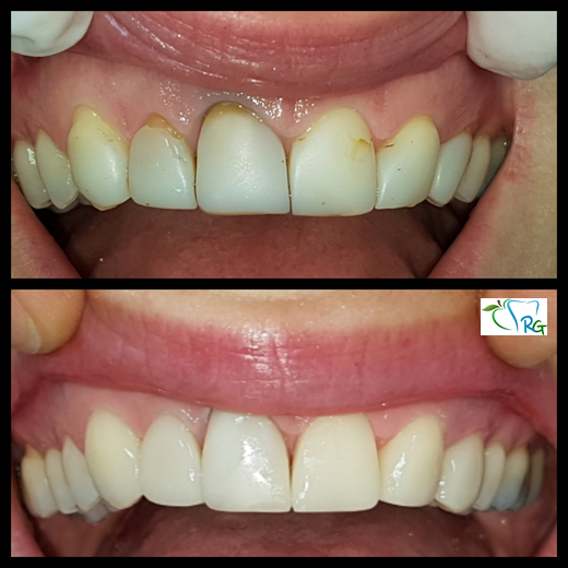 Faccette denti resina - Dott.Riccardo Giorgi Studi Dentistici a La Spezia