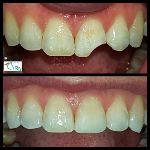 ricostruzione di dente rotto - Dott.Riccardo Giorgi Studi Dentistici a La Spezia