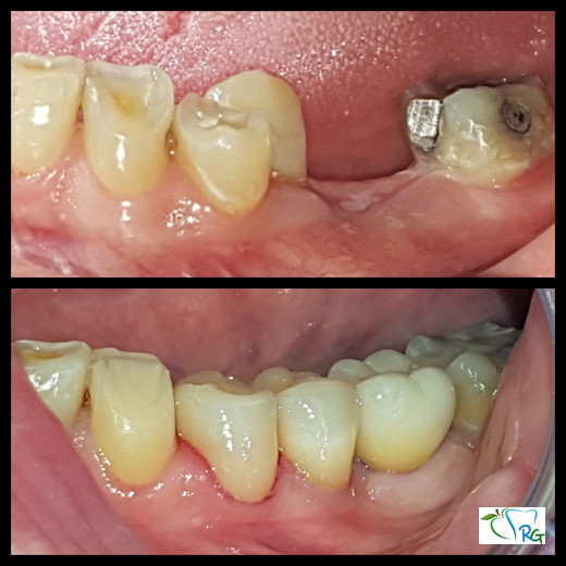 riabilitazione orale complessa - Dott.Riccardo Giorgi Studi Dentistici a La Spezia