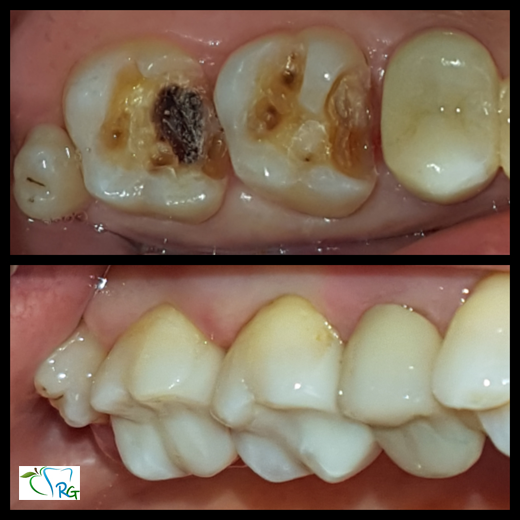 otturazioni resina composita - Dott.Riccardo Giorgi Studi Dentistici a La Spezia