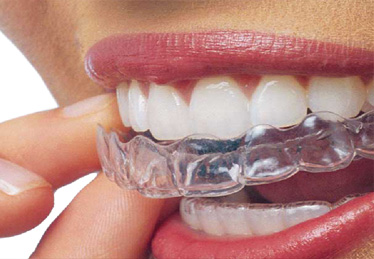 ortodonzia invisibile, invisalign - Dott.Riccardo Giorgi Studi Dentistici a La Spezia