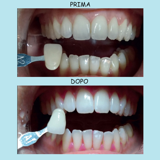 sbiancamento dentale - Dott.Riccardo Giorgi Studi Dentistici a La Spezia