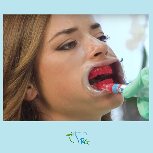 gel sbiancante denti - Dott.Riccardo Giorgi Studi Dentistici a La Spezia