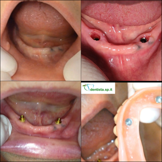 impianti dentali per femare protesi - Dott.Riccardo Giorgi Studi Dentistici a La Spezia