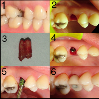 impianto postestrattivo a carico immediato - Dott.Riccardo Giorgi Studi Dentistici a La Spezia