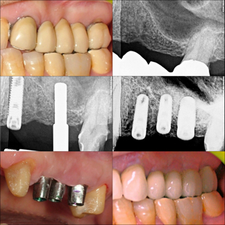 innesto di osso: mini rialzo di seno mascellare per implantologia dentale - Dott.Riccardo Giorgi Studi Dentistici a La Spezia