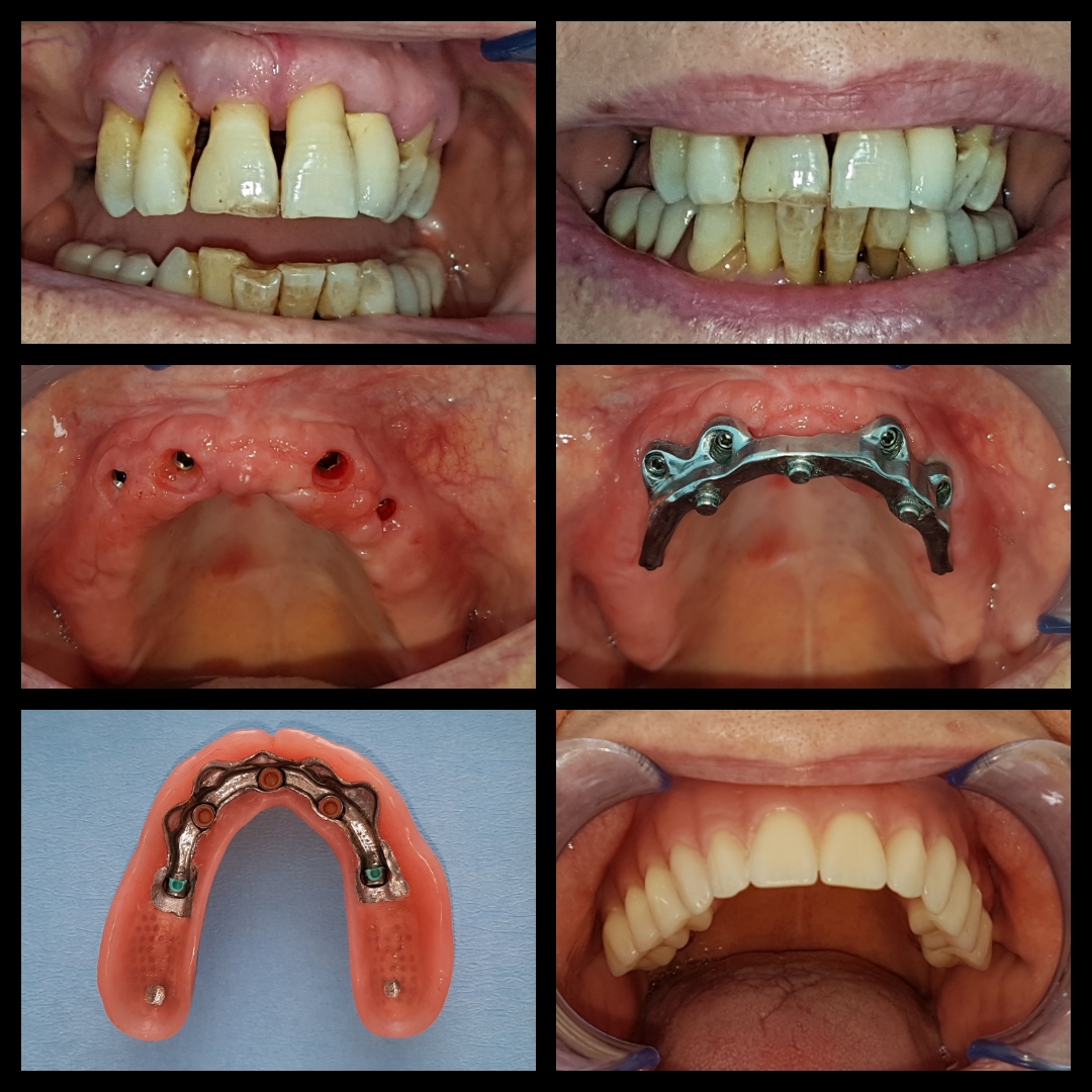 overdenture su barra con 4 impianti - Dott.Riccardo Giorgi Studi Dentistici a La Spezia