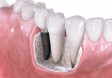 Implantologia - Dott.Riccardo Giorgi - Studi dentistici a La Spezia